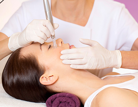 Microneedling new